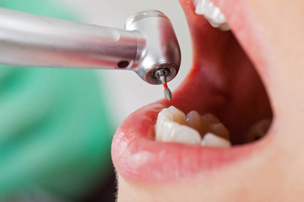 Best Emergency Root Canal Treatment in Springboro, OH